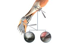 Seg-Way - Model EGR - Endoscopic Gastrocnemius Recession System