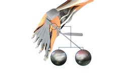 Seg-Way - Model EPF - Endoscopic Plantar Fasciitis System
