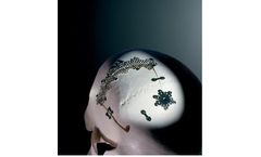 Precision-Surgical - Bioplate Cranial Fixation System