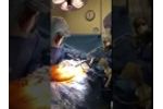 Universal Hip Stem Extraction - OR - Video