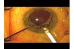 Malyugin Ring Insertion and Removal - Video