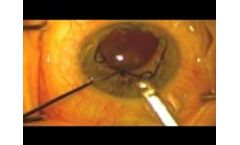 Malyugin Ring Insertion and Removal - Video