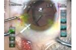 Cataract Surgery with MST Capsule Retractors - Video