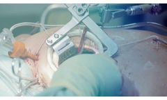 Fehling -- MICS Retractor System - Video