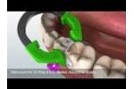 Using the Triodent V3 System - Video