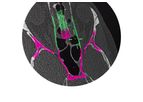 Brainlab - Electromagnetic ENT Navigation