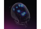 Brainlab - Manage Multiple Brain Metastases
