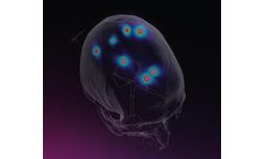 Brainlab - Manage Multiple Brain Metastases