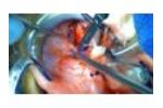 SurgiCam HD Example Footage - Video