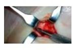 Example of SurgiCam HD Footage (Hand Surgery) - Video
