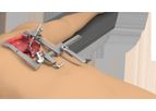 Thompson - Bolling Retractor System