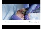 MicroAire SmartDriver - Provided Exclusively by Securos Surgical - Video