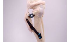 Securos - Model XGEN - Tibial Tuberosity Advancement (TTA) System