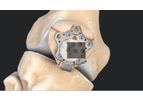 Arthrex - Model II – 3 mm - Patella Suture Plate System