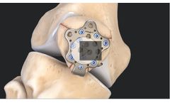 Arthrex - Model II – 3 mm - Patella Suture Plate System