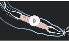 GraftLink - ACL Reconstruction Backup Fixation System