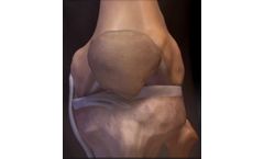 Arthrex SwiveLock - Medial Patellofemoral Ligament RepairInterference Screw
