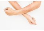 Treating Psoriasis