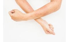 Treating Psoriasis