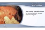 Removal of Skin Lesions with the MCL31 Dermablate Erbium Laser by Asclepion - Video