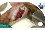 Wound Healing Cases Collection - Case 01 Surgical Dehiscence - Video