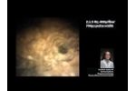 Staghorn Stone by Dr. Kelly Healy - Video