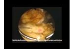 Enucleation by Dr. Akhil K. Das, M.D., F.A.C.S. - Video