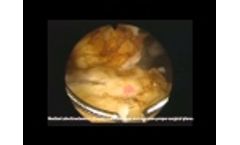 Enucleation by Dr. Akhil K. Das, M.D., F.A.C.S. - Video