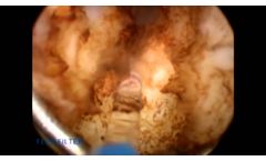 MELA by Dr. Paul M. Arnold, M.D., F.A.C.S. - Video