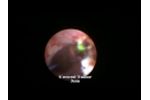 Ureteral Tumor by Dr. Kelly Healy - Video
