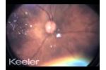 ROP Dark fundus mini clip - Video