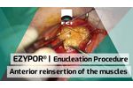 EZYPOR | Enucleation | Anterior reinsertion of the muscles - Video