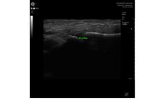 Handheld Ultrasound Devices for Clinical Value - MSK
