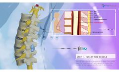Introduction of EpiFaith syringe by Flat Medical - Video