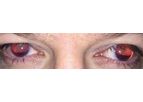 Customflex Artificialiris - Medical Device