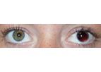 Customflex Artificialiris - Custom-Color Match Medical Device