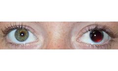 Customflex Artificialiris - Custom-Color Match Medical Device