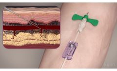 Kurin Blood Culture Collection Set with Flash Technology - Video