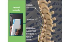 Auctus - Dynamic Scoliosis Tethering System