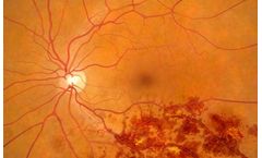 Retinal Vein Occlusion (RVO)