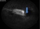 Cerevast - Microsphere-Mediated Ophthalmic Ultrasound