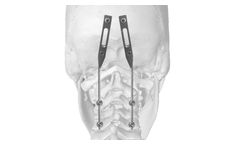 J.O.C. - Rod-Plates for Occipito-Cervical Arthrodesis