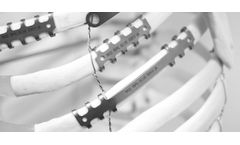 ThoRib - Thoracic Osteosynthesis System