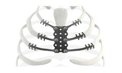 Neuro - Model Trionyx - Sternal Replacement Implant