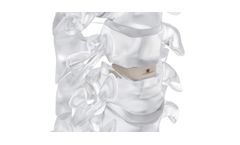 Neuro - Model Pm Cage - Anterior Cervical Interbody Fusion Cage