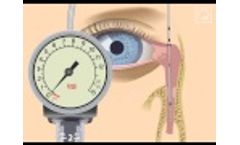 LacriCATH DCP Animation - Video