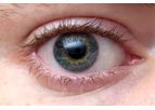 Bioengineered Cornea