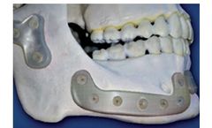 Bionacre - Bone Replacement Technology