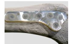 Bionacre - Bone Grafts