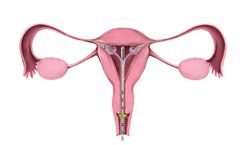 FemBloc - Permanent Birth Control Device